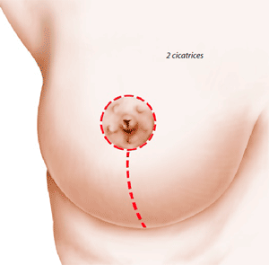 Mammoplastie vue par les femmes
