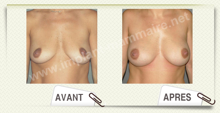 chirurgie esthetique des seins