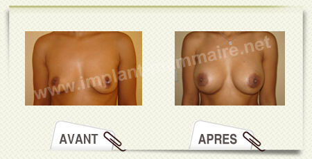 chirurgie esthetique augmentation mammaire