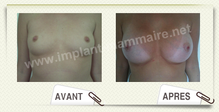 chirurgie augmentation mammaire