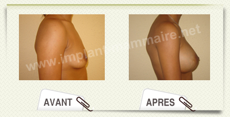 chirurgie esthetique augmentation mammaire