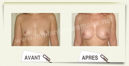 chirurgie augmentation mammaire