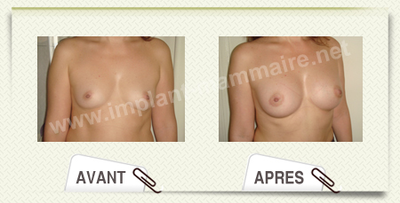 chirurgie augmentation mammaire
